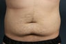 CoolSculpting