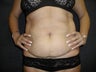 Tummy Tuck