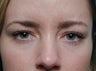 Botox for Frown Lines