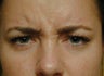 Botox for Frown Lines