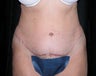 Tummy Tuck