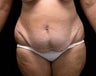 Tummy Tuck