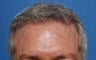 50 year old gentleman treated for hair loss and high hairline 