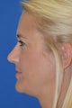 Rhinoplasty