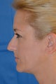 Rhinoplasty
