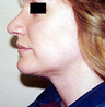 Chin Implant 