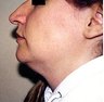 Chin Implant 