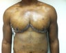 Male Breast Reduction