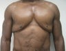 Male Breast Reduction