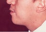 Male Chin Augmentation