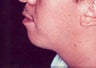Male Chin Augmentation