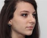Before and 2 month after rhinoplasty photos