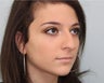 Before and 2 month after rhinoplasty photos