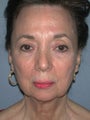 Chin Surgery on 65-year-old