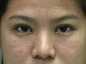 20 year old female desires an upper eyelid fold