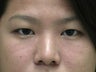 20 year old female desires an upper eyelid fold