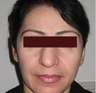 Botox
