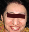 Botox