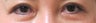 Bilateral Asian Blepharoplasty