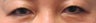 Bilateral Asian Blepharoplasty