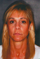 Laser Skin Resurfacing