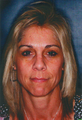 Laser Skin Resurfacing