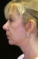 Facelift