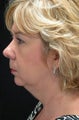 Facelift