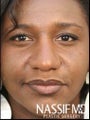 African American Female Rhinoplasty 
