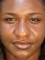 African American Female Rhinoplasty 