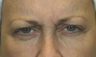 Botox Results