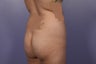 Butt Augmentation