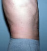 Male Liposuction