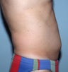 Male Liposuction