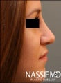 Female Primary Rhinoplasty 