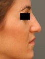 Female Primary Rhinoplasty 