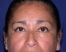 Eyelid Surgery