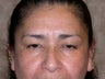 Eyelid Surgery