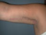 Arm Lift (Brachioplasty) on 34-year-old