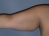 Arm Lift (Brachioplasty) on 34-year-old