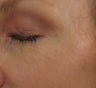 Crows feet after a single 1540 Lux Fractional Laser Treatment