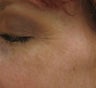 Crows feet after a single 1540 Lux Fractional Laser Treatment