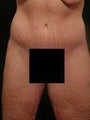 45 year old woman abdominoplasty/mommy makeover