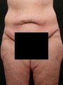 45 year old woman abdominoplasty/mommy makeover