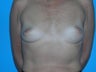 42 yr old with Saline Breast Implants