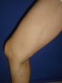 50 year old man with varicose veins