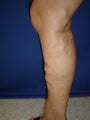 50 year old man with varicose veins