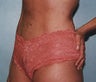 42 year old female patient 