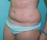 42 year old female patient 