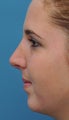 Rhinoplasty